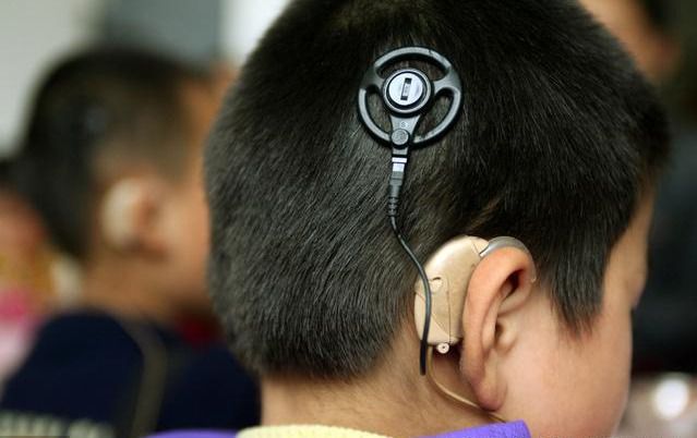 人工耳蜗购置＋手术补贴8.2万元！温州已有67名患儿受益